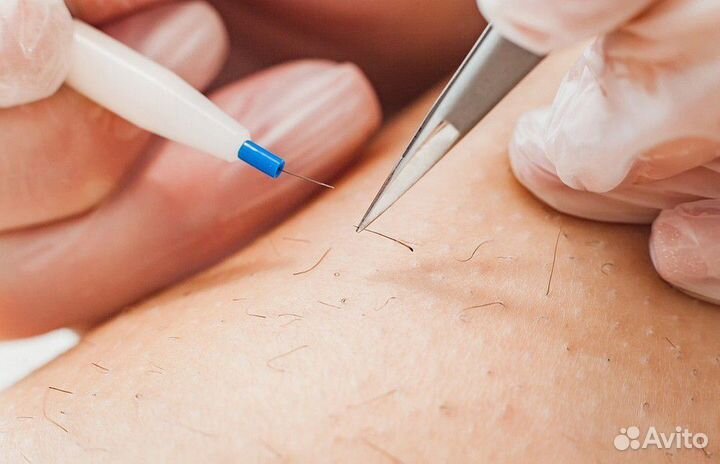 Электроэпиляция