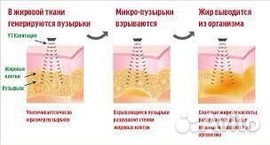 Кавитация ультразвуковая и RF-лифтинг