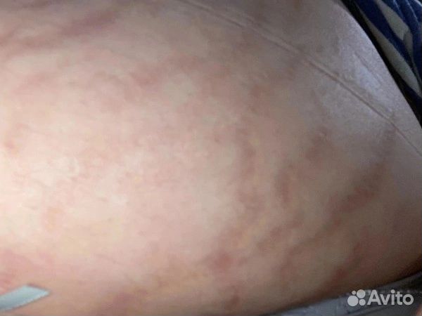 Сыворотка от растяжек