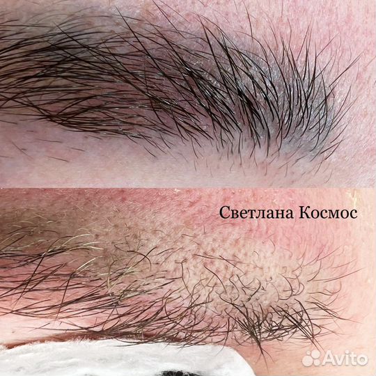 Удаление тату и татуажа лазером и ремувером