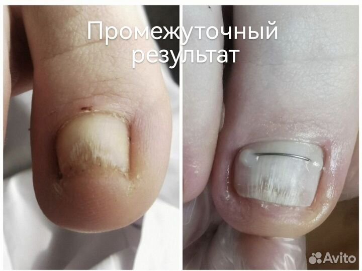 Медицинский педикюр, подолог