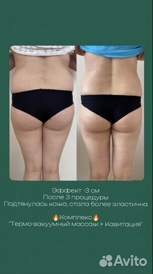 Аппаратный вакуумный массаж