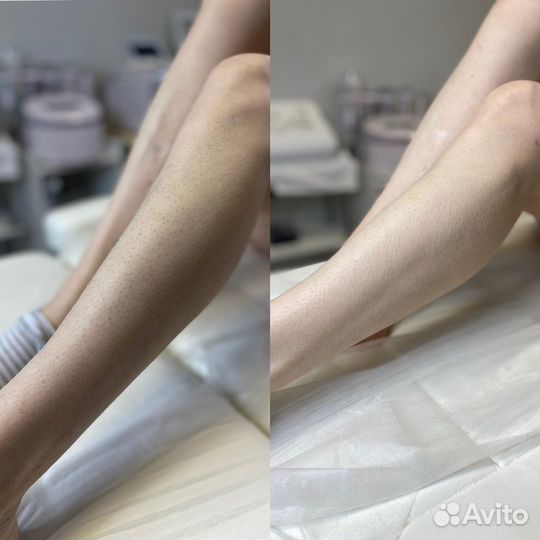 Шугаринг депиляция