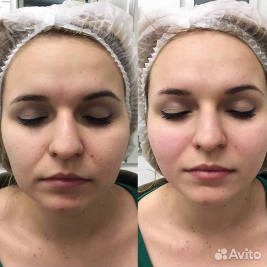 Скульптурный массаж лица