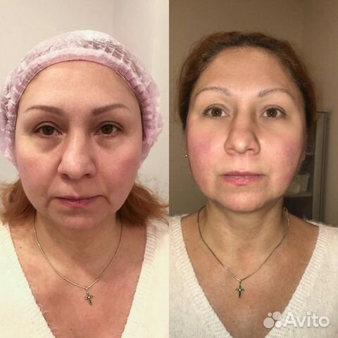 Смас лифтинг процедура Москва