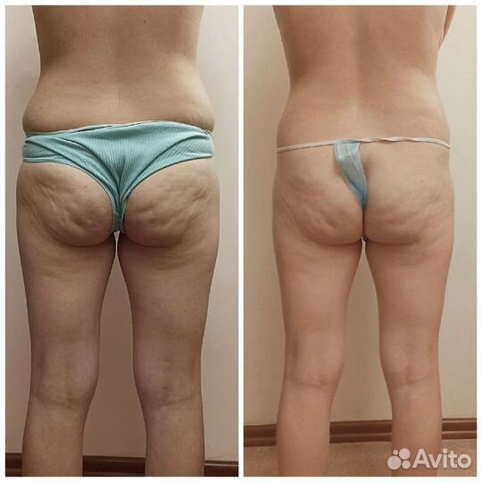 Lpg массаж /Velashape