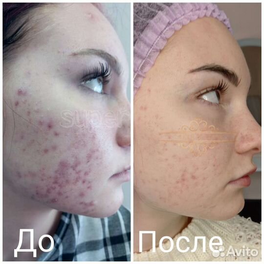 Процедуры холодной плазмы