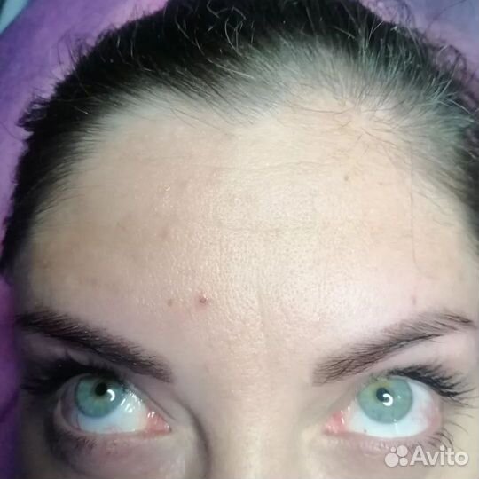 Ботокс для лица плюс коррекция бесплатно