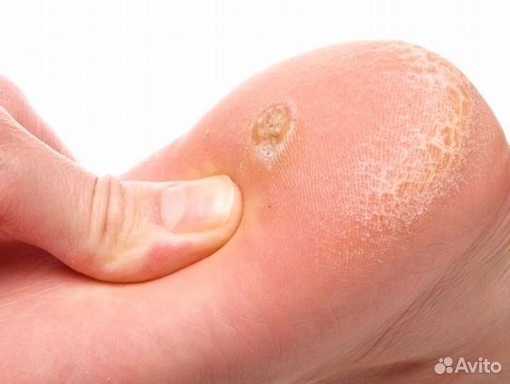 Удаление бородавок