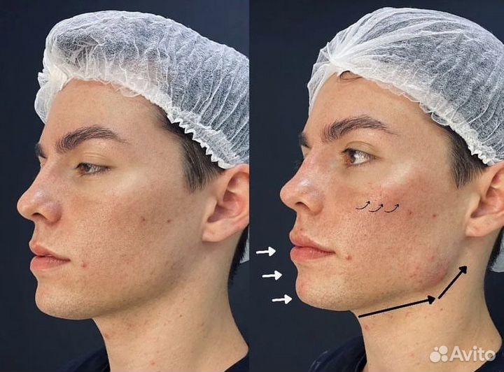 Full face омоложение