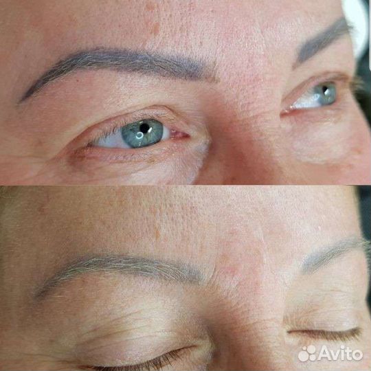 Удаление старого татуажа или тату