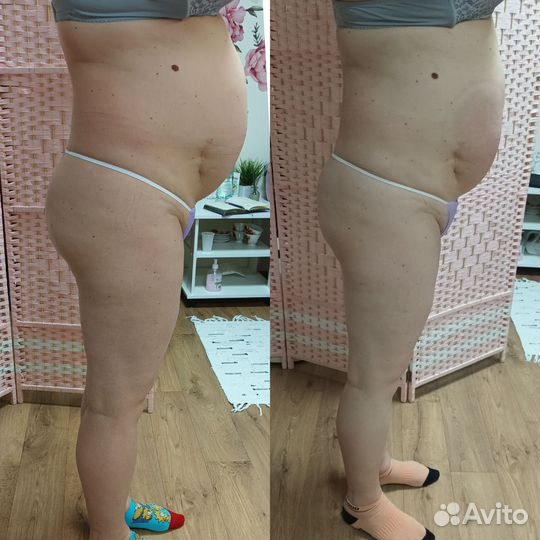 Вибро,вакуумный,вакуумно роликовый массаж