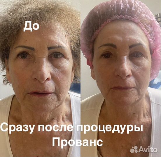 Модели на СМАС лифтинг