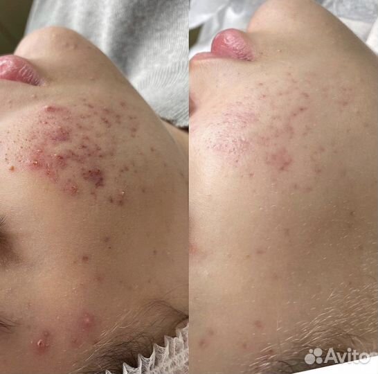 Чистка лица