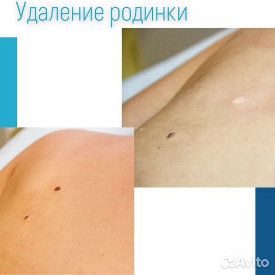 Удаление родинок лазером