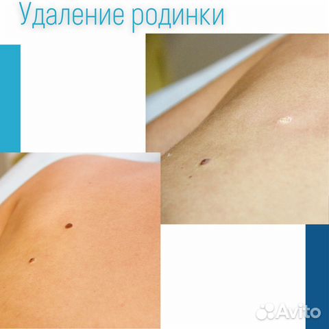 Удаление родинок лазером