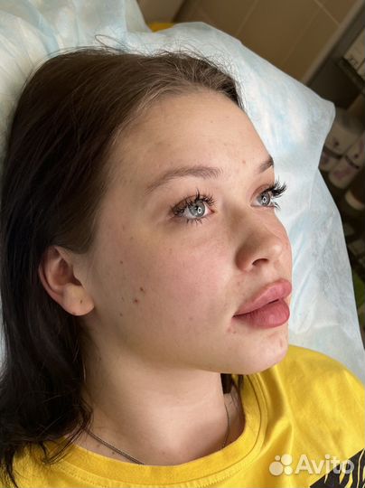 Увеличение губ, косметолог