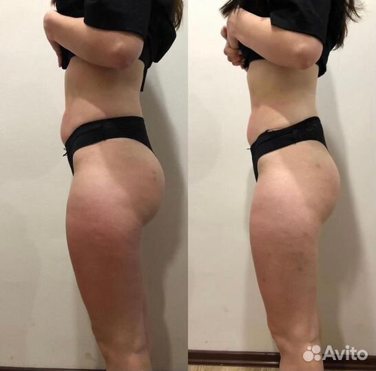 Антицеллюлитный / лечебный массаж