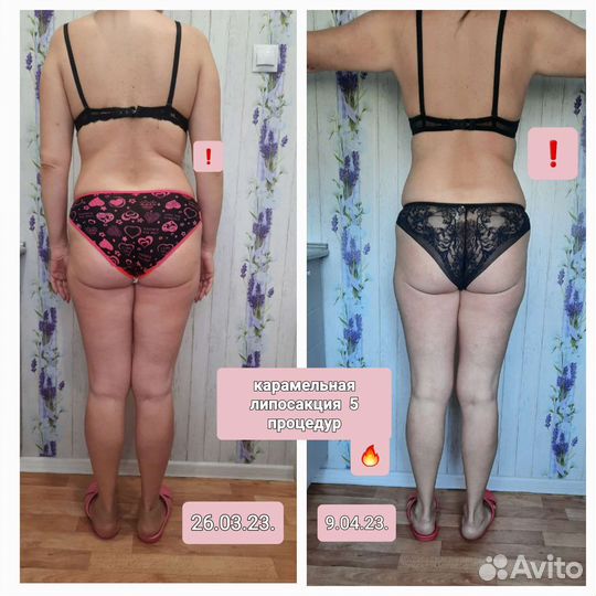 Коррекция фигуры. Липосакция карамельная. Лифтинг