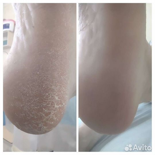 Аппаратный маникюр, Смарт-педикюр С-Чемской