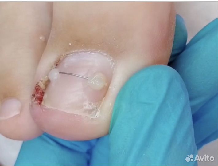 Подолог / Лечебный педикюр / Медицинский педикюр