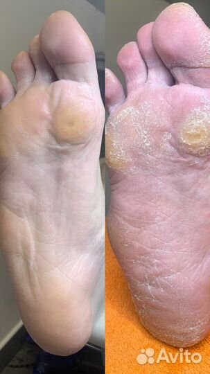 Подолог, медицинский педикюр, титановая нить