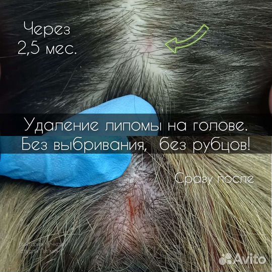 Удaление родинок, папиллом, бородавок