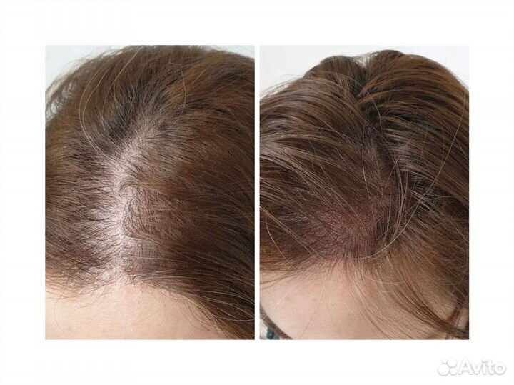 Трихопигментация головы/облысение