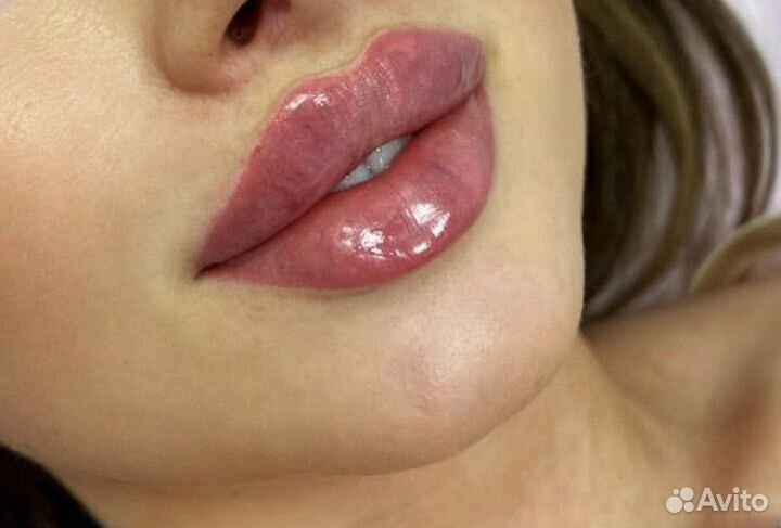 Увеличение губ