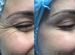 Ботулотоксин/Ботокс(botox) /Ботулинотерапия