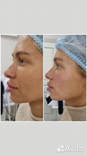 BTL Exilis бтл