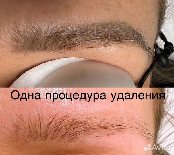 Удаление татуировок