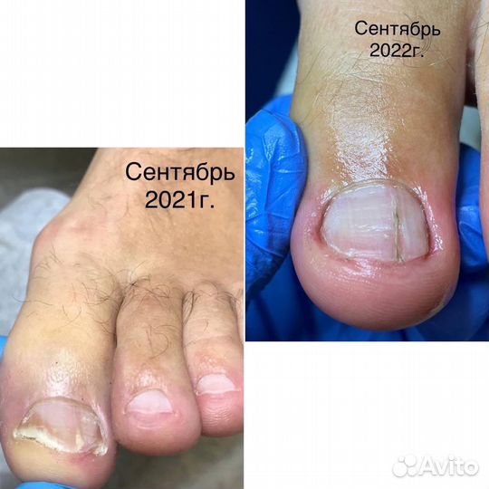 Лечебный педикюр подолог