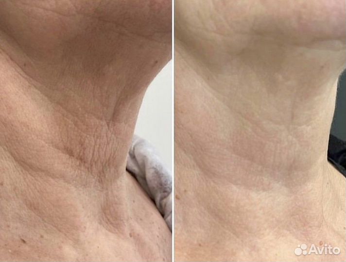 Микроигольчатый RF лифтинг лица