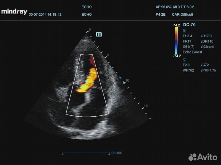 Узи аппарат Mindray DC-70 Pro