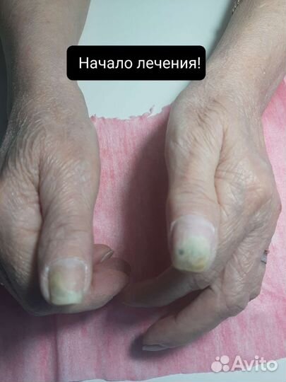 Педикюр Подология