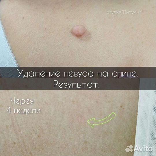 Удaление родинок, папиллом, бородавок