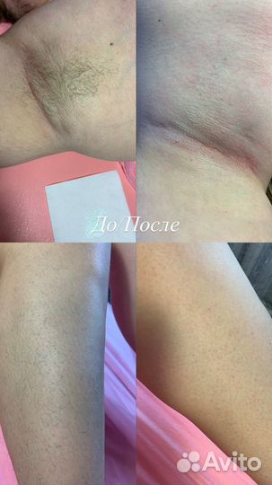 Шугаринг Витязево