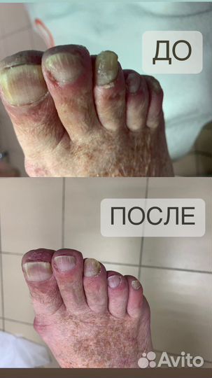 Подолог педикюр