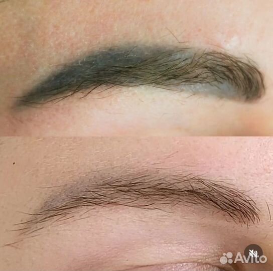 Удаление татуажа