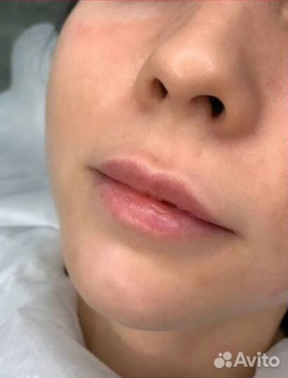 Увеличение губ. Плоский бант