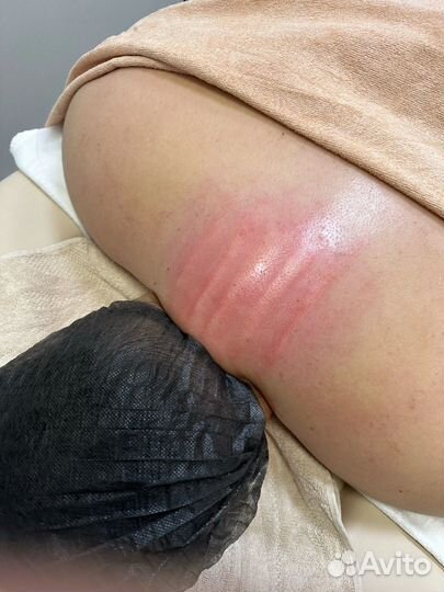 Безоперационно убираю – «вдовий горбик», «холку»