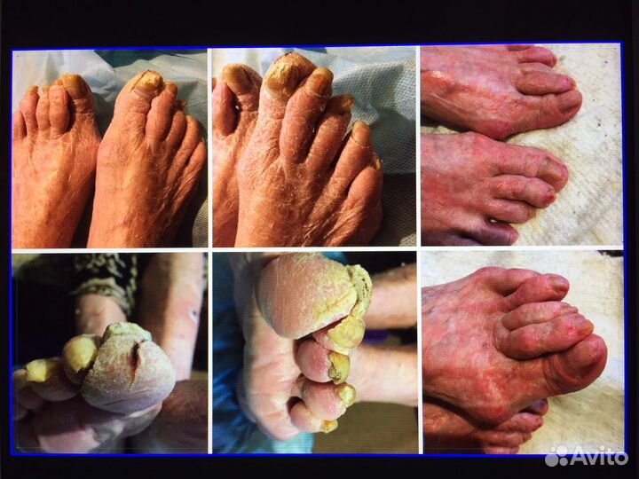 Вросший ноготь, бородавки, педикюр, грибок ногтей