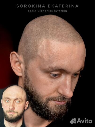 Трихопигментация головы