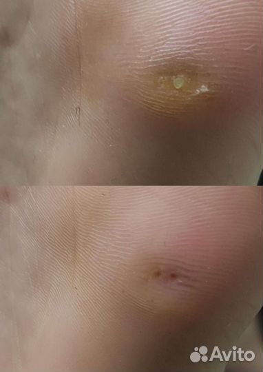 Лечебный педикюр подолог