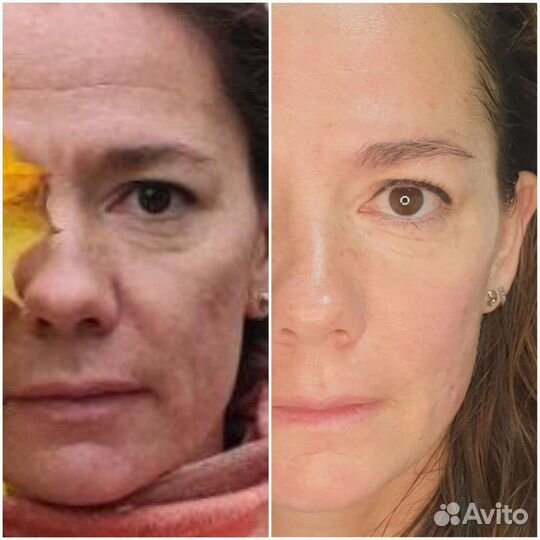 Омолаживающий Массаж лица