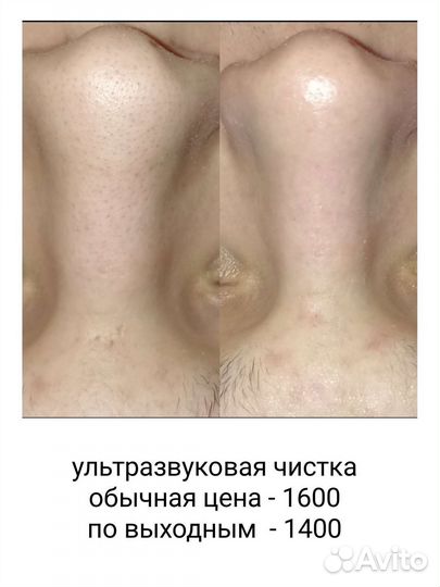 Ультразвуковая чистка лица