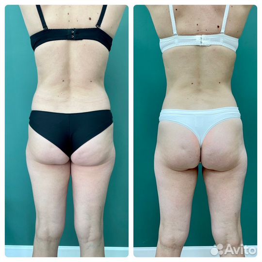 Роликовый массаж сферами