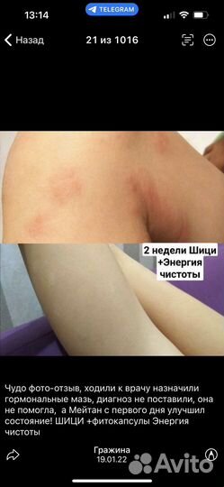 Крем Шици от псориаза