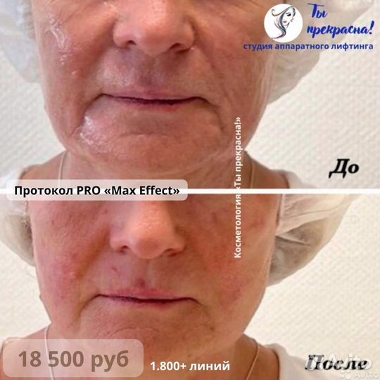 СМАС лифтинг подтяжка лица/ Омоложение/ Косметолог
